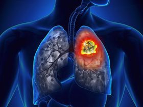 U phổi ác tính giai đoạn 4 có thể điều trị hay không?